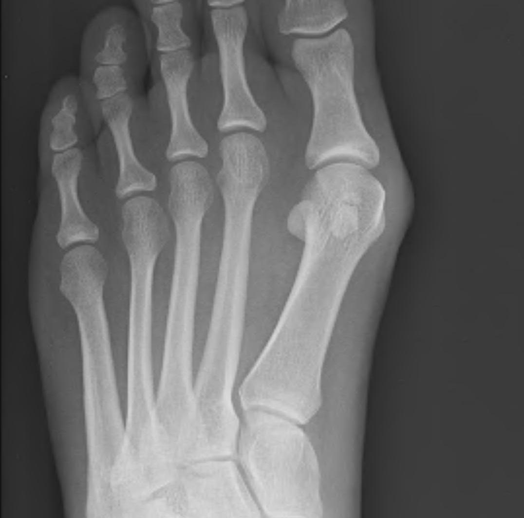 Metatarsalgia Short 1st Metatarsal